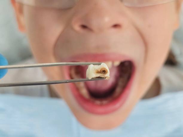 Best Emergency Tooth Extraction in Ballenger Creek, MD
